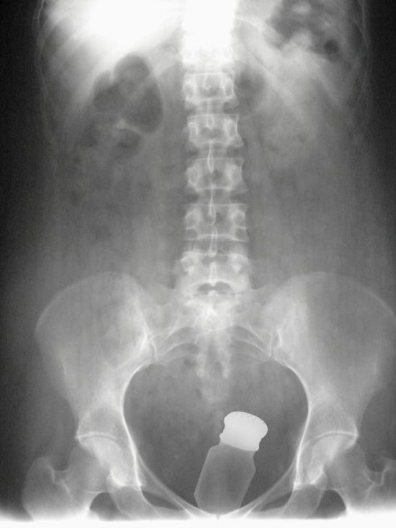 People sure do like sticking stuff that doesn't belong there up their butts.