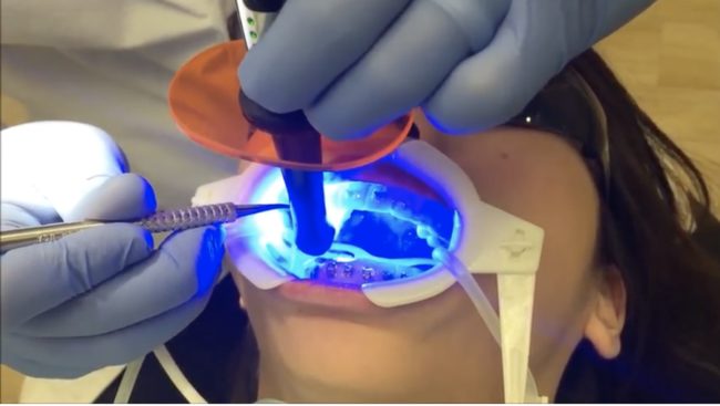 With your veneers in place, your dentist will then shine a "curing" light on your teeth to activate the bonding agent and the cement, which forces them to set in place as quickly as possible. And in just a minute's time, the entire veneer procedure is done.