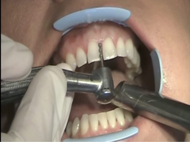 On average, 0.5 to 0.7 millimeters of the enamel is removed.