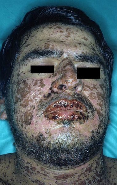 It can be caused by anti-gout medications, over-the-counter pain relievers, medications used to treat infection, seizures, or mental illness, and radiation therapy.It has also been linked to herpes, pneumonia, HIV, and hepatitis.