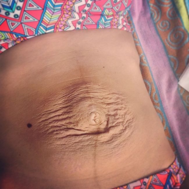 After having the baby in 2016, she was diagnosed withdiastasis recti, a condition that causes abdominal muscles to separate during pregnancy to give the baby enough room to grow.