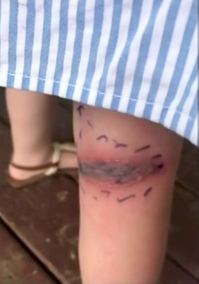 Even though she was on antibiotics, the bite didn't seem to be getting any better. That's when they rushed her to the hospital, where an infectious disease specialist said that she was bitten by a black widow spider.