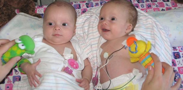 But everything started changing when they were put back together during the second round of their treatments. At three months old, they were able to go home. That Christmas, the Dunns learned that their babies were in remission.