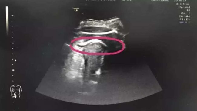 In a matter of minutes, Zhang was rushed to an operating table, where doctors discovered that the unborn fetus’ legs were poking into her abdominal cavity.
