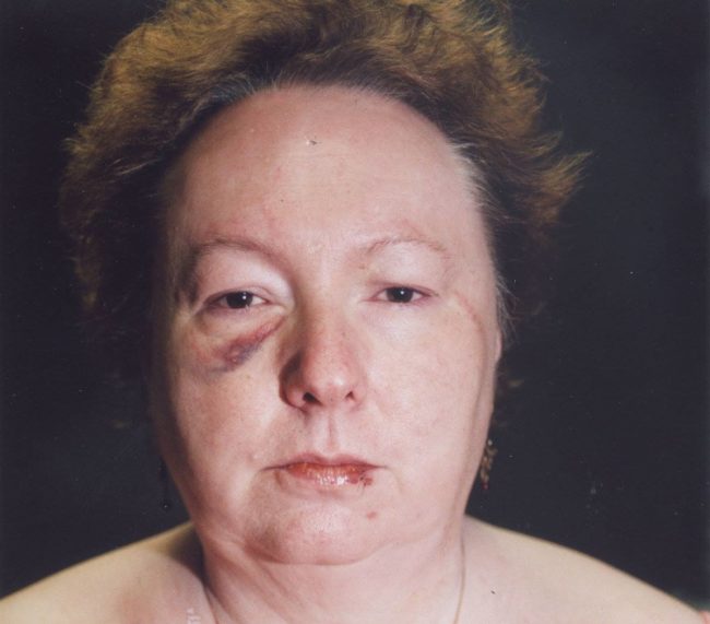 With a surge of adrenaline, Walters was able to wrestle the hammer out of his hands and swung at the man's skull with the claw of the tool. When he lunged at her to get the weapon back, she went for his throat to save her own life.