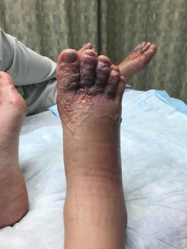 Thankfully for Zytner and Stephens, the condition typically goes away without treatment, although antiparasitic creams and medication will help alleviate the pain.