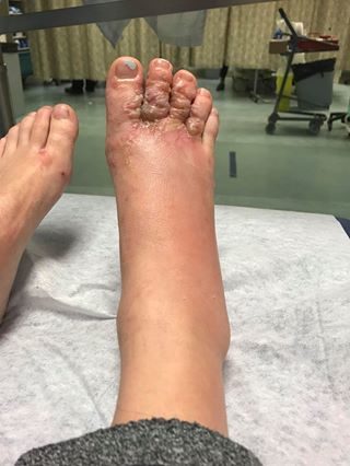 After multiple visits to the hospital, the couple was finally diagnosed with cutaneous larva migrans. This, the doctors believed, was the result of hookworm larvae entering their bodies while the couple walked around barefoot at the beach. Basically, they had worms in their feet.