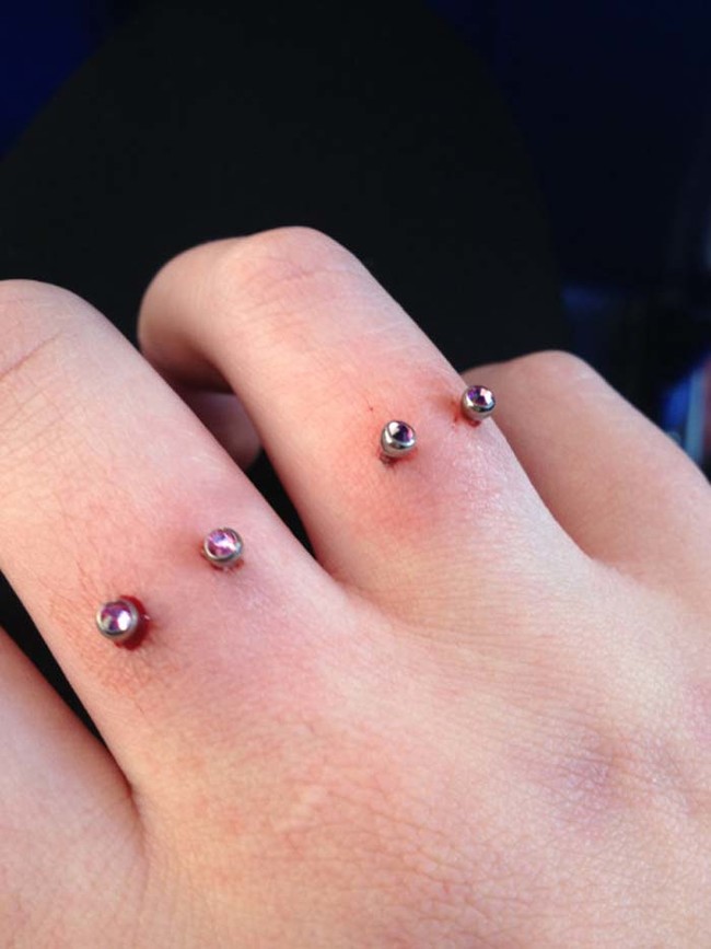 A different form of subdermal implant.